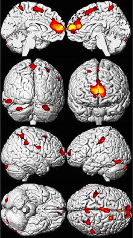 El envenenamiento por plomo es un tipo de envenenamiento causado por plomo en el cuerpo y el cerebro es el órgano más sensible a sufrir las consecuencias.