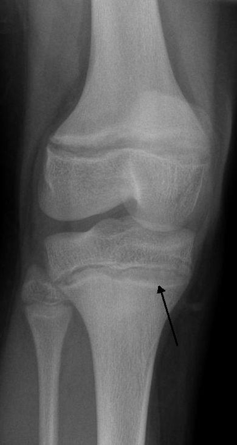 El plomo elevado también puede ser detectado por cambios en los glóbulos rojos o líneas densas en los huesos de los niños, como se ve en esta radiografía.