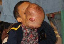 Un grupo de cirujanos extirparán el 12 de enero próximo un tumor facial benigno de 4,53 kilogramos a un niño cubano de 14 años.