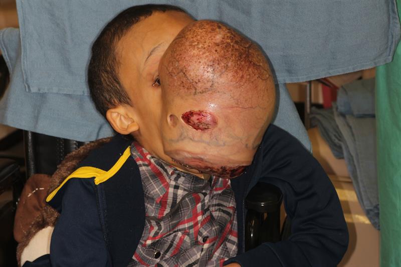 Un grupo de cirujanos extirparán el 12 de enero próximo un tumor facial benigno de 4,53 kilogramos a un niño cubano de 14 años.