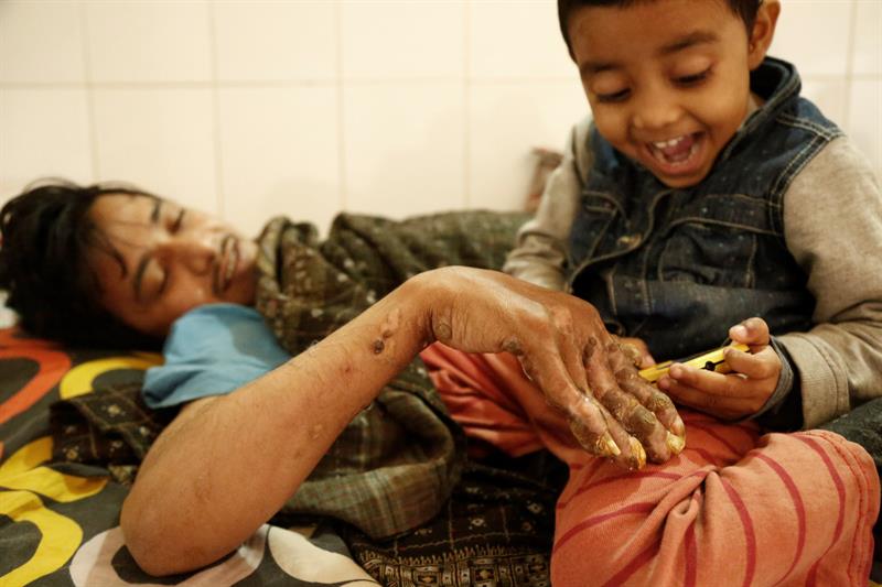 Abul Bajandar (izda), conocido como 'hombre árbol', juega con su hija, Jannatul Ferdous Tahira(dcha), en una habitación de la unidad de quemados del hospital, en Daca, Bangladés