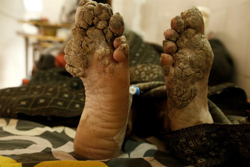 Abul Bajandar, conocido como 'hombre árbol', descansa en una habitación de la unidad de quemados del hospital, en Daca, Bangladés