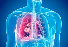 Esta neoplasia es el segundo cáncer más común y afecta tanto a hombres como a mujeres mayores de 65 años de edad.