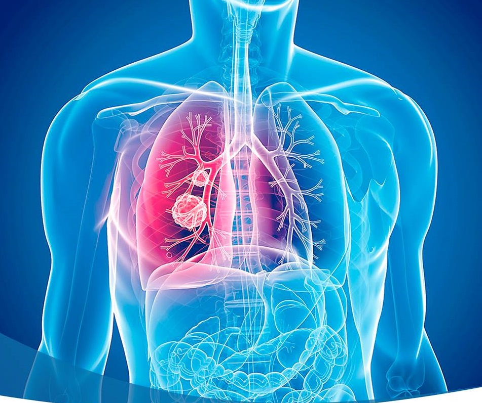 Esta neoplasia es el segundo c&aacute;ncer m&aacute;s com&uacute;n y afecta tanto a hombres como a mujeres mayores de 65 a&ntilde;os de edad. 