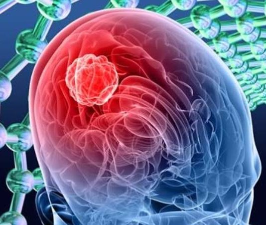 El 25 % de los casos de cáncer de pulmón desarrollan metástasis cerebral