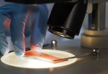 El trabajo demuestra que tanto FERMT2 como p62 podrían convertirse en un marcador pronóstico de la evolución de la enfermedad en los pacientes.