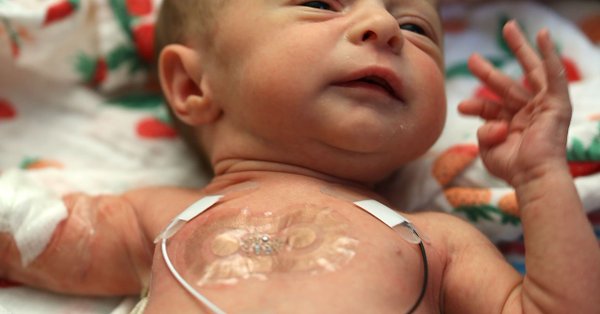 Los sensores, se adhieren a la piel de los ni&ntilde;os mediante parches, resultan adem&aacute;s menos lesivos para los neonatos.
