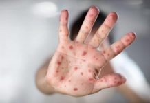 Brote de sarampión en comunidad judía ultraortodoxa de Nueva York acentúa tensión antisemita La gran mayoría de los contagiados son menores y el brote ha afectado especialmente a judíos ultraortodoxos.