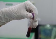 El riesgo de no vacunar al nacer contra la hepatitis B Las autoridades sanitarias de Florida confirmaron la detección de 690 casos de hepatitis A entre el 1 de enero de 2019 y el 31 de marzo pasado
