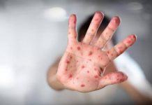 Las autoridades sanitarias confirmaron en lo que va de año 695 casos de sarampión, una cifra récord desde que el país declaró la enfermedad erradicada en el año 2000