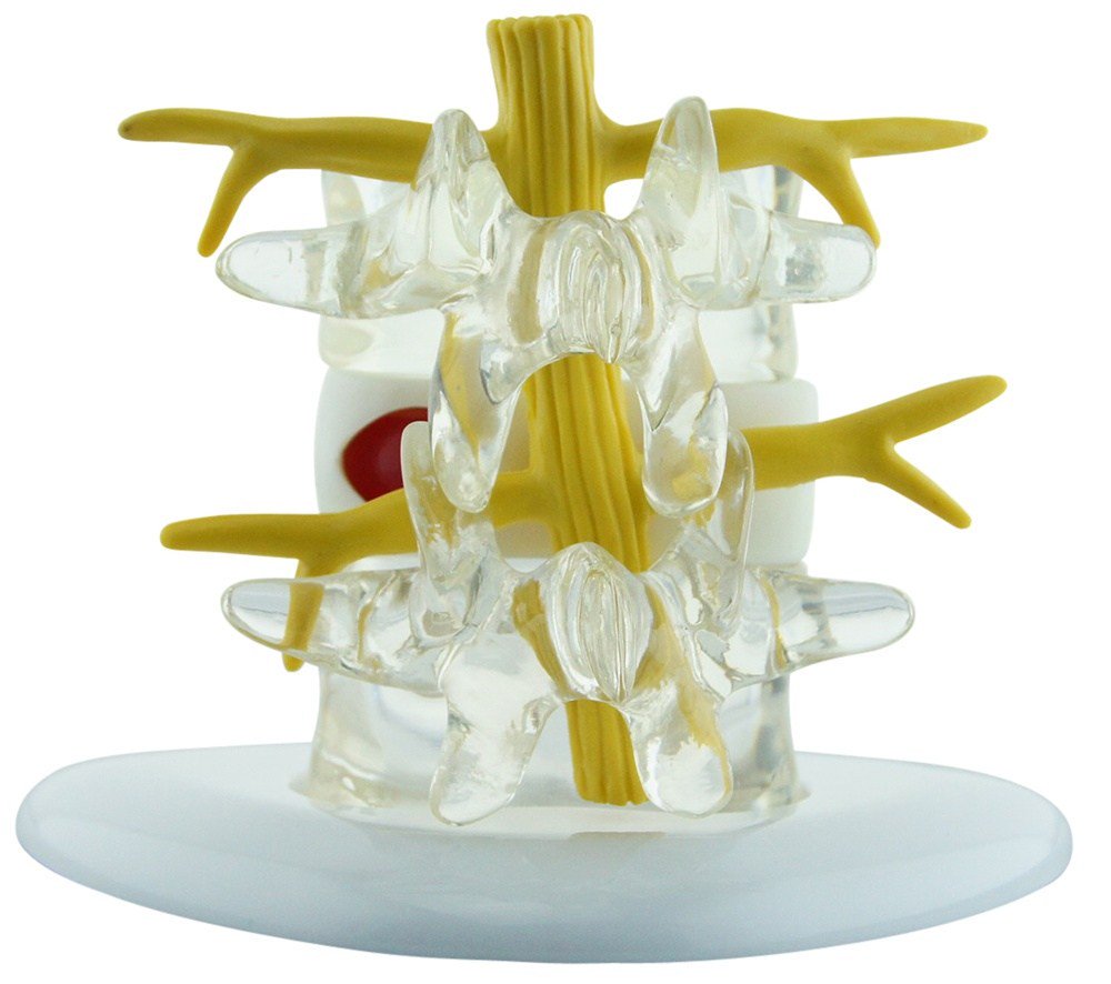 La electroestimulaci&oacute;n y los ejercicios de Williams podr&iacute;an ser eficaces para disminuir el dolor secundario de hernia lumbar.