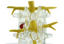 La electroestimulación y los ejercicios de Williams podrían ser eficaces para disminuir el dolor secundario de hernia lumbar.