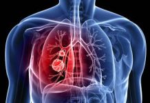 Científicos de Google y de la Universidad estadounidense de Northwestern han desarrollado un sistema de inteligencia artificial capaz de detectar cáncer de pulmón