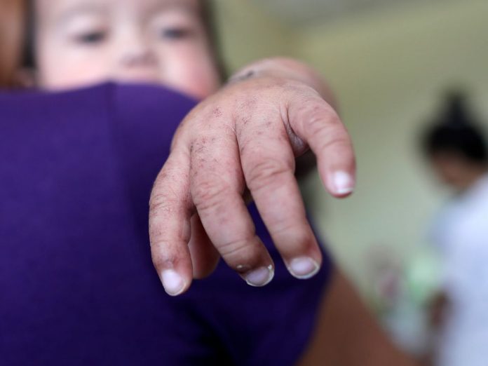 Los casos de sarampión en el país siguen subiendo y ya hay 839 confirmados en un total de 23 estados