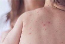 Estados Unidos podría dejar de ser un país libre de sarampión Ante el aumento de casos de sarampión reportados en Estados Unidos, como medida de precaución, la Cámara de Representantes de Puerto Rico aprobó este jueves una medida