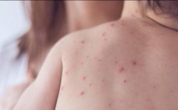 No obligar a vacunar a los niños contra el sarampión provocaría la mayor epidemia de EE.UU. Ante el aumento de casos de sarampión reportados en Estados Unidos, como medida de precaución, la Cámara de Representantes de Puerto Rico aprobó este jueves una medida