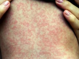 Pensilvania reporta la tercera muerte por sarampión del año en EE.UU. ante contagios récord Se han diagnosticado 550 personas con sarampión hasta el 28 de mayo de 2019 y desde el inicio del brote el pasado octubre.