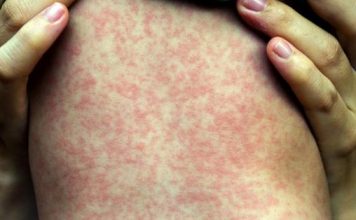 Se han diagnosticado 550 personas con sarampión hasta el 28 de mayo de 2019 y desde el inicio del brote el pasado octubre.