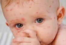 La varicela es una enfermedad infecciosa considerada, de manera errónea, como benigna.