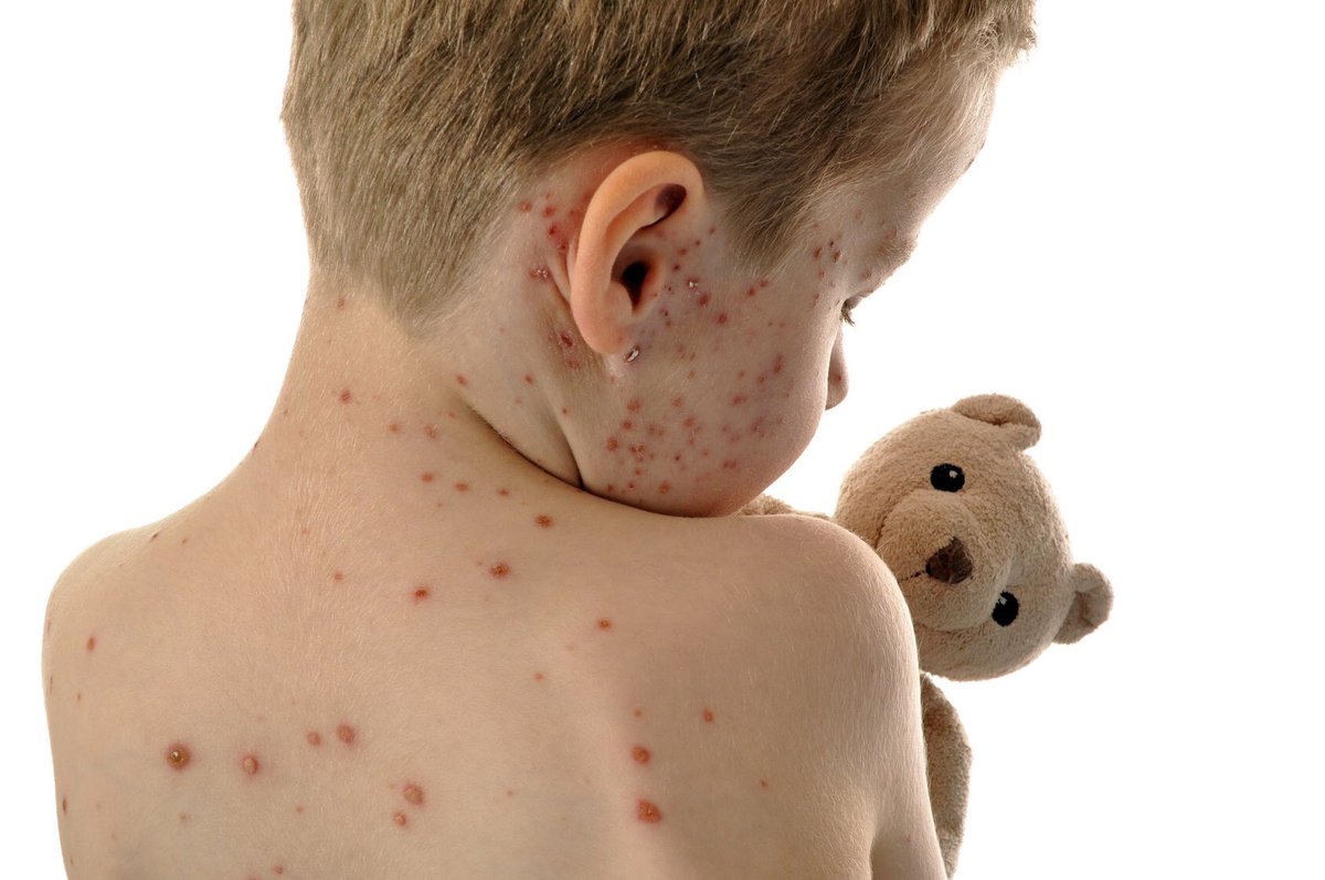 El sarampión es tan contagioso que hasta el 90% de las personas cercanas a un paciente infectado —que no estuvieran vacunadas o protegidas por naturalmente por haber padecido la enfermedad— se infectarán.