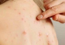 La vacuna contra la varicela reduce el riesgo de contraer la "culebrilla" la vacuna "reduce la posibilidad de culebrilla en los niños, destacando el doble beneficio de esta vacuna contra la varicela".
