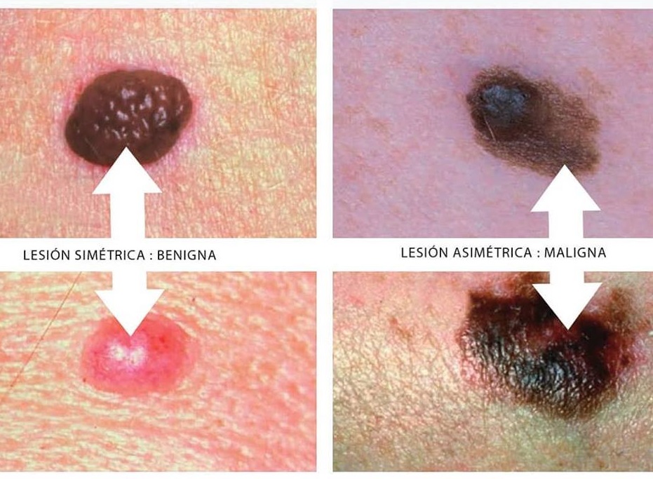 El onc&oacute;logo destac&oacute; que el melanoma es muy agresivo y puede hacer "met&aacute;stasis en piel, tejidos blandos, hueso, pulm&oacute;n, h&iacute;gado y sistema nervioso central.