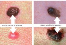 Melanoma provoca muerte a 70 % de quienes lo padecen por diagnóstico tardío El oncólogo destacó que el melanoma es muy agresivo y puede hacer "metástasis en piel, tejidos blandos, hueso, pulmón, hígado y sistema nervioso central.