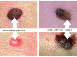 Melanoma provoca muerte a 70 % de quienes lo padecen por diagnóstico tardío El oncólogo destacó que el melanoma es muy agresivo y puede hacer "metástasis en piel, tejidos blandos, hueso, pulmón, hígado y sistema nervioso central.