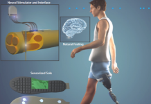 Una pierna artificial ayuda a sentir su uso La prótesis, probada en dos pacientes, está equipada con sensores externos que representan el tacto y la presión del pie.