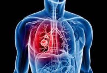 El cáncer de pulmón, que en México causa unas 8.000 mil muertes al año, tiene ahora nuevos tratamientos