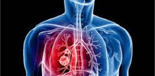 El cáncer de pulmón, que en México causa unas 8.000 mil muertes al año, tiene ahora nuevos tratamientos