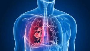 En el total del periodo en estudio, los mayores avances se dieron en las tasas de mortalidad por cáncer de pulmón, que disminuyeron el 51 % en los hombres y el 26 % en las mujeres.