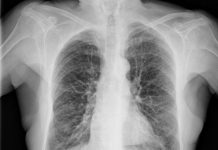 El coronavirus podría seguir oculto en los pulmones de pacientes aparentemente recuperados y que ya no muestren síntomas