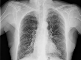 El coronavirus podría seguir oculto en los pulmones de pacientes aparentemente recuperados y que ya no muestren síntomas