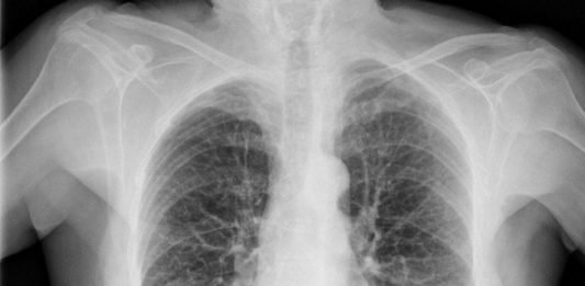 El coronavirus podría seguir oculto en los pulmones de pacientes aparentemente recuperados y que ya no muestren síntomas