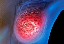 La verdad sobre el cáncer de mama y la píldora