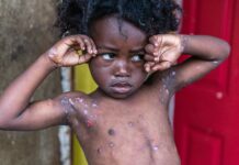 Una contagiosa enfermedad cutánea hace estragos en zonas rurales de Haití