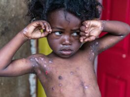 Una contagiosa enfermedad cutánea hace estragos en zonas rurales de Haití