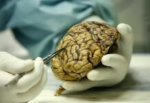 Expertos de Florida estudian el uso de ultrasonido en pacientes con Alzheimer Alzheimer