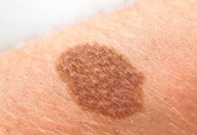 El cáncer de piel siempre es un riesgo, pero puede pasar inadvertido en pieles oscuras cáncer de piel.