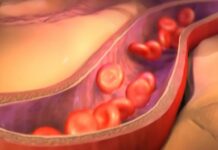 La aterosclerosis subclínica progresa a menudo en personas de mediana edad, especialmente cuando los niveles de colesterol y la tensión arterial están elevados.