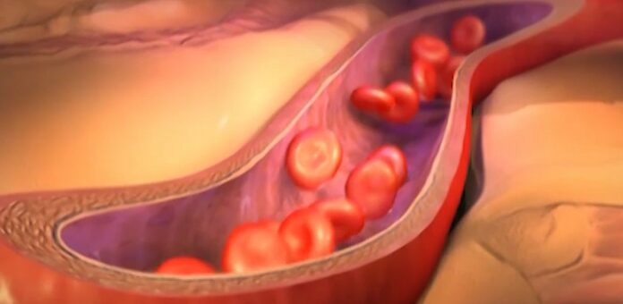 La aterosclerosis subclínica progresa a menudo en personas de mediana edad, especialmente cuando los niveles de colesterol y la tensión arterial están elevados.