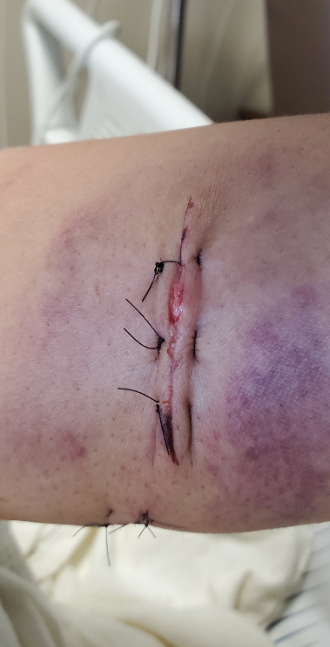 Bates_Arm_Stitches