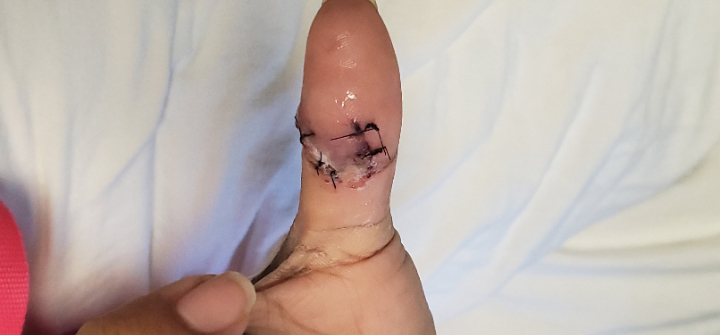 Bates_Finger