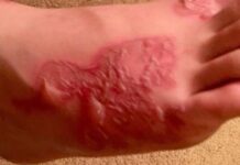 bacteria come carne